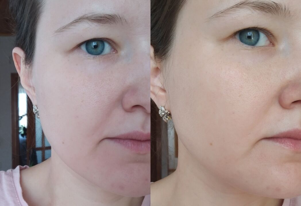 Inno Gialuron քսուք օգտագործելուց առաջ և հետո